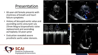 Valve-in-Valve TAVR: Snare Crossing Technique