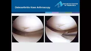 An Exploration of Alternative Osteoarthritis Therapy with Dr. Melvin A. Churchill