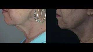 Fotona Lightwalker Laser , Necklase, neck collagen and skin  rejuvenation