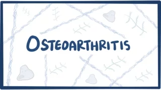 Osteoartrosi - cause, sintomi, diagnosi, trattamento e patologia