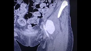 IV Drug User (IVDU) complications - pseudoaneurysm, arterial occlusions, stenoses and phlegmon