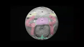 PARASELLAR TUMORS