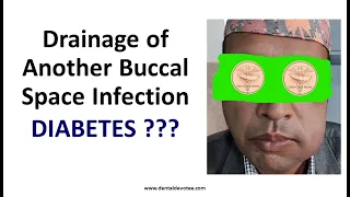 Intraoral Incision and Drainage of Buccal space infection by Dr. Raman Dhungel