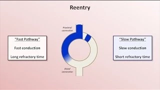 Intro to EKG Interpretation - Mechanisms of Tachyarrhythmias