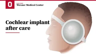 Cochlear implant after care | Ohio State Medical Center