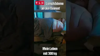 Riesige Lymphödeme am Bein | Mein Leben mit 300 kg | #shorts | TLC Deutschland