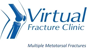 Multiple Metatarsal Fractures