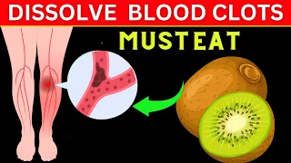 Top 8 Foods to Dissolve Blood Clots Naturally| Health matters