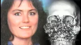 Woman Has Near-Total Face Transplant