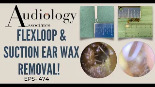 FLEXLOOP & SUCTION EAR WAX REMOVAL - EP474