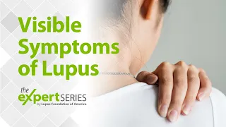 The Expert Series S6E2: Visible Symptoms of Lupus