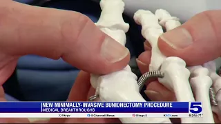 Medical Breakthrough: New minimally-invasive bunionectomy procedure
