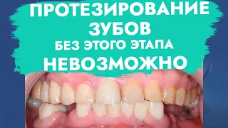 Протезирование зубов без этого этапа невозможно.