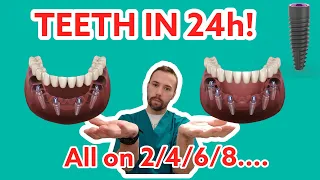 Dentist teaches patients: All on 4 vs 6 vs 8 in 24h