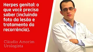 Herpes genital: o que você precisa saber (incluindo foto da lesão e tratamento da e recorrência).