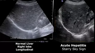 Liver Ultrasound Normal Vs Abnormal Image Appearances Comparison | Liver Ultrasound Pathologies