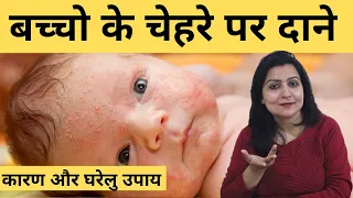बच्चों के चेहरे पर दाने का इलाज |baby acne in hindi | baby acne treatment | My baby care