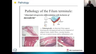 Untethering of Spinal Cord -  Dr Ricardo Santos de Oliveira