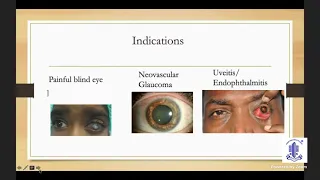 PG Update Series on  ORBIT & OCULAR ONCOLOGY -  Dr.Dayakar Yadalla