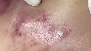 SAC DEP SPA Blackheads | #692