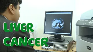 What Is Liver Cancer? (Symptoms, Causes & Treatments)  - Macmillan Cancer Support