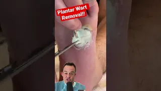 DOCTOR REACTS: SATISFYING WART REMOVAL!😱 #shorts