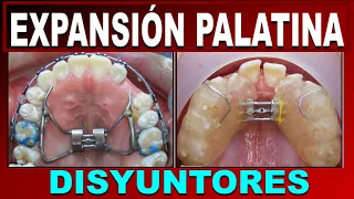 PALATE EXPANSION IN MAXILLARY ORTHOPEDICS WITH CIRCUIT BREAKER IN PALATE