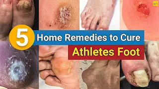 5 Home Remedies to Cure Your Athlete's Foot Permanently! | Credihealth #infection #homeremedies