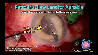 CataractCoach™ 1921: retro iris claw lens for aphakia