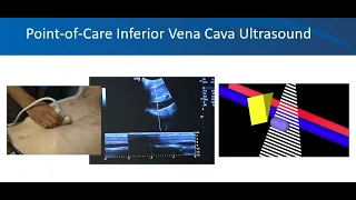 Renal ultrasound video 3, Volume status, University of Florida Nephrology, Dr. Koratala (@NephroP)