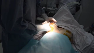 Увеличение груди имплантами. Видео с операционной!