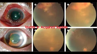 Uveitis in Acquired Syphilis #KanskiSeries #2022