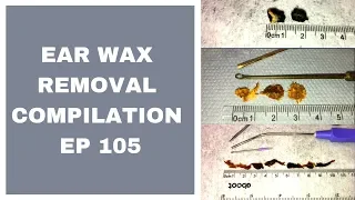 EAR WAX REMOVAL COMPILATION   EP 105