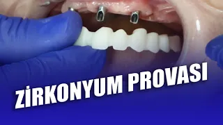 Zirkonyum Provası Nasıl Yapılır? İmplant Üstü Zirkonyum Kaplama Provası