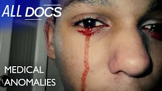 The Boy With Bloody Tears | S01 E04 | Extraordinary People Documentary | All Documentary