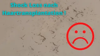 Shock Loss nach Haartransplantation!