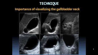 Basic Gallbladder