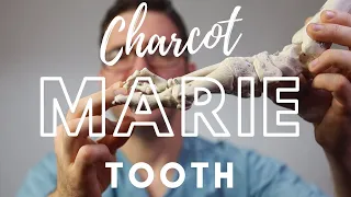 Charcot Marie Tooth Disease [Best Foot Treatment!]