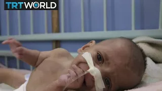 The War in Syria: Rebel-held Eastern Ghouta faces malnutrition