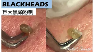 Taiwan Tainan台南清粉刺最乾淨_InitialBeauty - 巨大黑頭粉刺( Blackheads Removal)