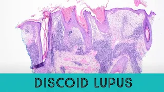 Discoid Lupus Erythematosus under the microscope (pathology dermatology dermpath)