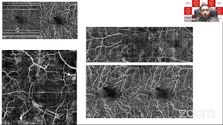 Webinar 1. Topic 1. OCT Angiography - Basic, Nuances & Pitfalls. by Dr.Unni Krishnan Nair