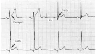 Podcast 846: Early Repolarization vs. Anterior STEMI