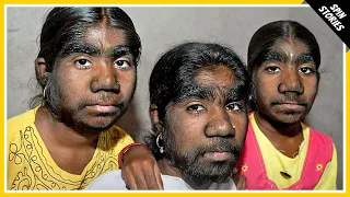 Three sisters with 'Werewolf Syndrome' finally show their faces to the world!