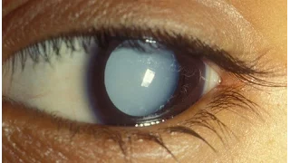 Cataract, Aphakia and Pseudophakia Examination