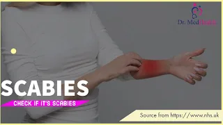 Scabies causes symptoms and treatment | Complications of scabies