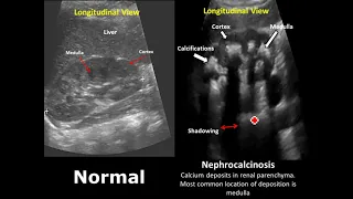 Kidney, Ureter and Bladder (KUB) Ultrasound Normal Vs Abnormal Image Appearances Comparison