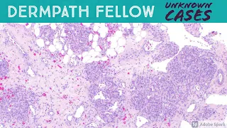 Dermpath Fellow Slide Session: Kaposiform hemangioendothelioma, plexiform fibrohistiocytic tumor etc