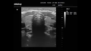 Видеозапись УЗИ - Отсутствие перешейка щитовидной железы