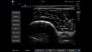 Ultrasound to find deep peroneal nerve in 10 sec (with caption)